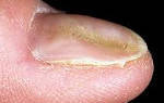 Почему ногти меняют форму. Определение болезней по ногтям рук