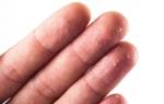 Что делать при трещинах на пальцах рук. Трещины на руках, пальцах: причины и лечение. Причины появления трещин на коже рук