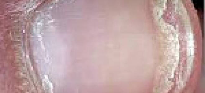 Причины и лечение ломких и тонких ногтей. Ногти слоятся и ломаются: причины проблемы и лечение