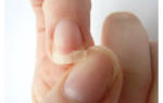 Дистрофия ногтей что это. Болезни ногтей, при которых изменяется их форма и размер