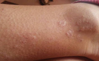 Шелушится кожа на голени ног причины. Почему шелушится сухая кожа на ногах: что делать и как лечить дерматит
