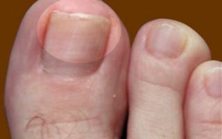 Как выглядит начальная стадия грибка ногтей на руках и ногах? Грибок ногтей на ногах чем лечить в домашних условиях