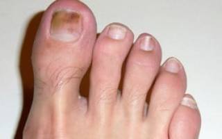 Лечение нитей мицелия на ногтях и коже ног. Нити мицелия — симптомы и диагностика, пути заражения и методы лечения