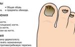Чем лечить грибок ногтей на ногах в домашних условиях. Как можно избавиться от грибка ногтей на ногах в домашних условиях быстро и легко