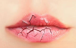 Пересыхание губ причина. От чего сохнут губы