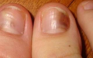 Народная медицина от грибка ногтей на ногах. Препараты и народные средства для лечения грибка на ногтях пальцев ног