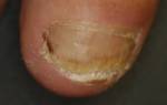Как вылечить сильный грибок ногтей. Интересные факты о хозяйственном мыле. Средства от грибка ногтей на ногах