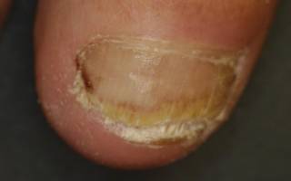 Как вылечить сильный грибок ногтей. Интересные факты о хозяйственном мыле. Средства от грибка ногтей на ногах