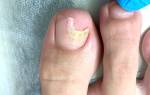 Ноготь отслаивается от ногтевой пластины причины. Причины отслоения ногтевой пластины от пальца и методы лечения