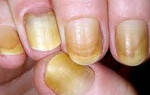 Причины жёлтых ногтей на руках: как бороться с проблемой. Почему желтеют ногти на руках