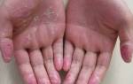 Как увлажнить руки в домашних условиях отзывы. Сухая кожа рук: причины. Ванночки для лечения шелушения и сухости рук и ног