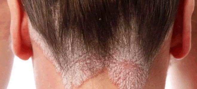 Сильные шелушения на коже головы. Здоровое и сбалансированное питание. Маска из сливок