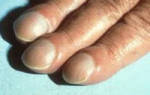 Ногти неровные что делать. Витаминотерапия против волнистых ногтей. Что делать и как лечить