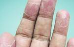 От чего шелушатся пальцы. Частое воздействие химических веществ. Шелушиться кожа на пальцах рук – как вернуть красоту пальчикам