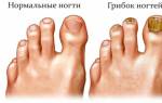 Какими народными средствами можно вылечить грибок ногтей. Грибок ногтей на ногах: чем лечить, самые эффективные средства