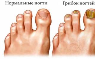 Какими народными средствами можно вылечить грибок ногтей. Грибок ногтей на ногах: чем лечить, самые эффективные средства