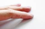 Трещины на руках мазь для лечения. Что делать, если трескается кожа на пальцах рук. Лечение трещин и сухости кожи рук
