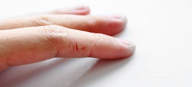 Трещины на руках мазь для лечения. Что делать, если трескается кожа на пальцах рук. Лечение трещин и сухости кожи рук