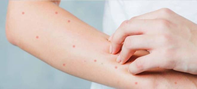 Лечение кожи после ветрянки у взрослых. Причины формирования шрамов. Чем мазать рубцы после ветрянки