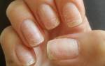 Грибок ногтей на руках: симптомы и лечение, начальная стадия. Как вылечить грибок ногтей на руках в домашних условиях быстро