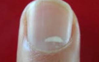 Белые пятна на ногтях рук — что это означает? Почему появляются белые пятна на ногтях