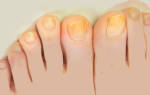 На ногтях появились серебристые пятна. Почему ногти на руках желтеют? Это причина тесно связана