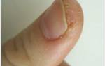 Сухая кожа у ногтей на руках. Как избавиться навсегда от трещин на пальцах рук у ногтя