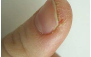 Сухая кожа у ногтей на руках. Как избавиться навсегда от трещин на пальцах рук у ногтя