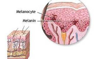 Причины и лечение пигментации кожи. Причины и патогенез альбинизма